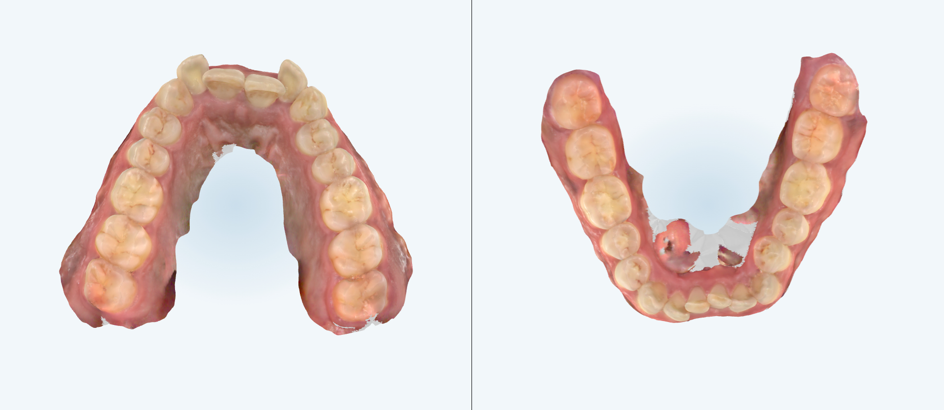 Dental expansion treatment comparison case 2 before